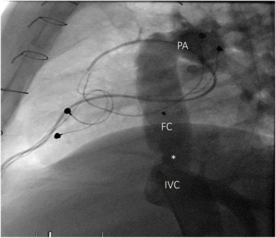 Transcatheter interventions in patients with a Fontan circulation: Current practice and future developments